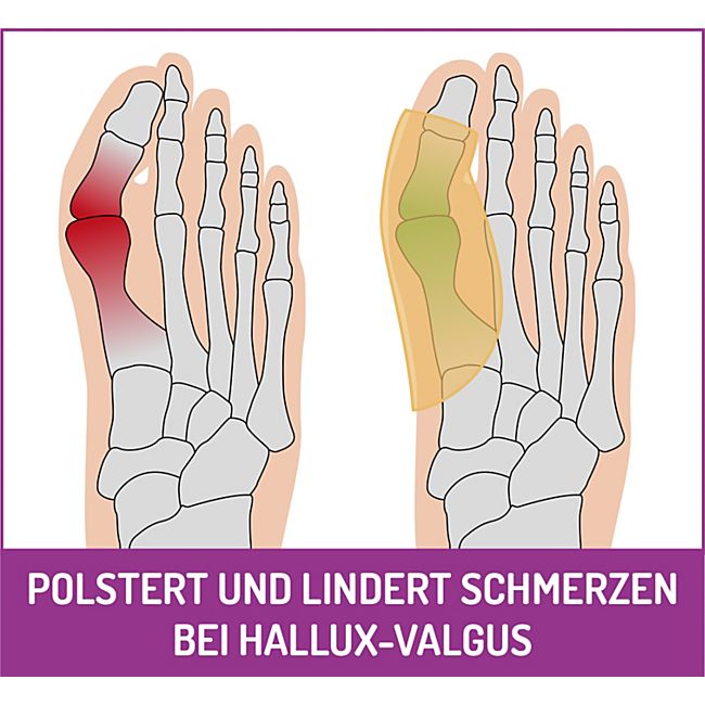 babybutt FußGut Hallux Überbeinschutz 1 Paar Bis zu 65% Rabatt